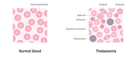 Thalassemia blood smear. The difference of Thalassemia and Normal blood.のイラスト素材