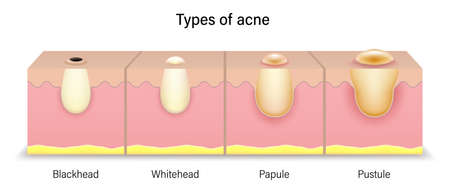 Types of acne. Human skin acne. Blackhead, Whitehead, Papule and Pustule. Vector for cosmetic advertisements.のイラスト素材