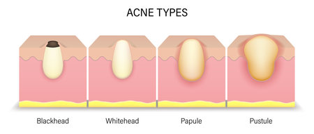 Acne types. Human skin acne. Blackhead, Whitehead, Papule and Pustule. Vector for advertising about beauty and medical treatment.のイラスト素材