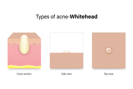Types of acne. Skin problems. Whitehad in cross section, side view and top view. Vector for advertising about beauty and medical treatment.のイラスト素材