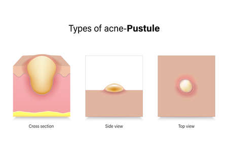 Types of acne. Skin problems. Pustule in cross section, side view and top view. Vector for advertising about beauty and medical treatment.のイラスト素材