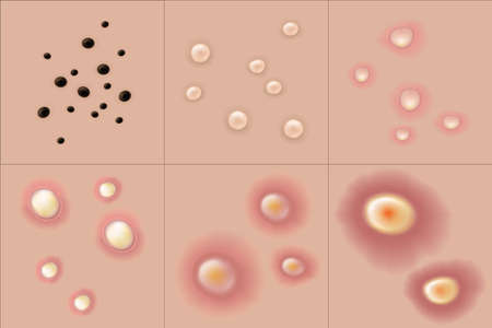 Types of acne. Skin problems. Blackheads, Whiteheads, Papules, Pustules, Nodules and cystics. Vector for advertising about beauty and medical treatment.のイラスト素材