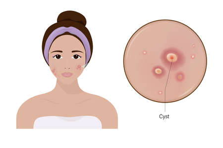 Woman with acne and a close up enlarged image of the facial skin showing cystics.&#xD;&#xA;Acne problem. Vector for cosmetic and beauty advertising.のイラスト素材