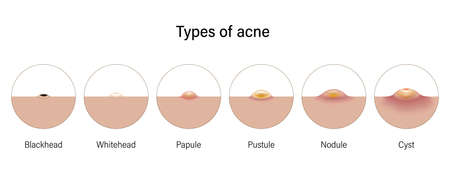 Skin problems. Acne types. Blackheads, Whiteheads, Papules, Pustules, Nodules and Cysts. Vector for advertising about beauty and medical treatment.のイラスト素材