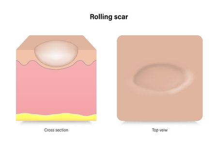 Rolling scar. Facial skin problems. Vector for advertising about beauty and medical treatment.のイラスト素材