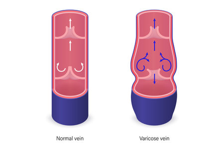 Varicose vein vector. The difference of normal vein and varicose vein.のイラスト素材