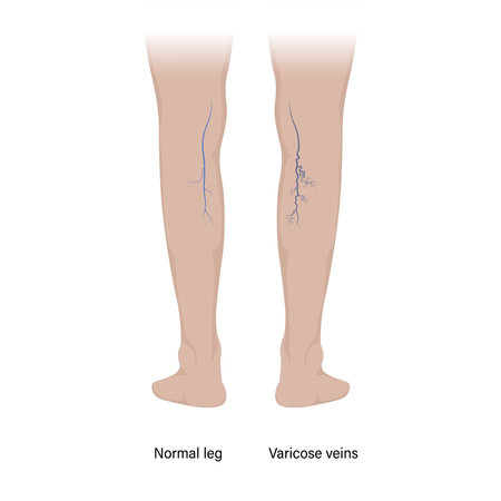 Legs with normal veins and legs with varicose veins.のイラスト素材