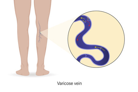 Close up of varicose veins. Cross section of varicose vein. Vector for use in scientific study and medical treatment.のイラスト素材