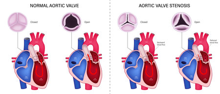 The difference of normal aortic valve and aortic valve stenosis. Valvular aortic stenosis. Heart anatomy vector. Close-up of normal and abnormal aortic valves.のイラスト素材