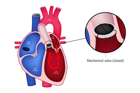 Aortic valve replacement with mechanical valve. Close up of open mechanical valve. Heart anatomy vector.のイラスト素材
