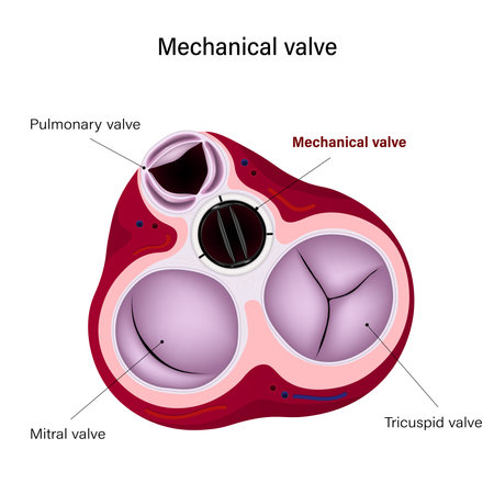 Mechanical valve. Aortic valve replacement. Heart anatomy vector. Heart valve repair.