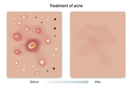 Treatment of acne. Skin before and after treatment. Blackheads, Whiteheads, Papules, Pustules, Nodules and Cysts. Vector for advertising about beauty and medical treatment.のイラスト素材