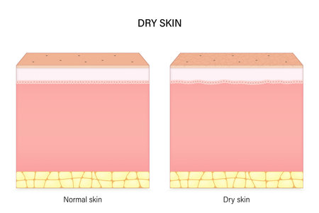 Dry skin. Comparison of normal and dry skin. Facial skin problems. Vector for advertising about beauty and medical treatment.のイラスト素材