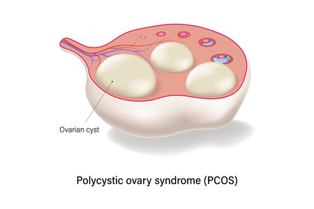 Polycystic ovary syndrome PCOS cross section vector. Ovarian cysts. Female ovarian disease.のイラスト素材