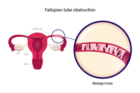 Fallopian tube obstruction. Block fallopian tube. occlusion is a major cause of female infertility.のイラスト素材