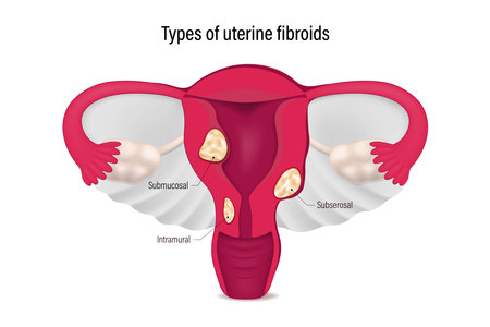 Types of uterine fibroids. Submucosal, Subserosal and Intramural fibroids. Female reproductive system.のイラスト素材