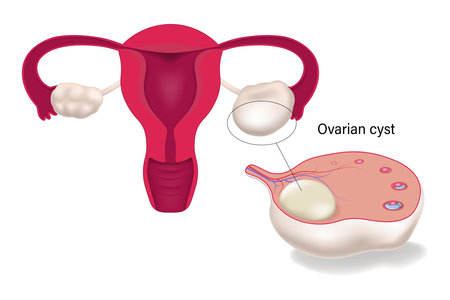 Ovarian cyst. Female reproductive system. Human uterus.のイラスト素材