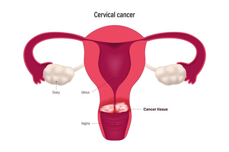 Cervical Cancer. Cervix carcinoma. Female reproductive system disease.のイラスト素材