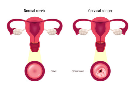 Comparison of normal cervix and cervical cancer. Cervix carcinoma. Female reproductive system disease.のイラスト素材