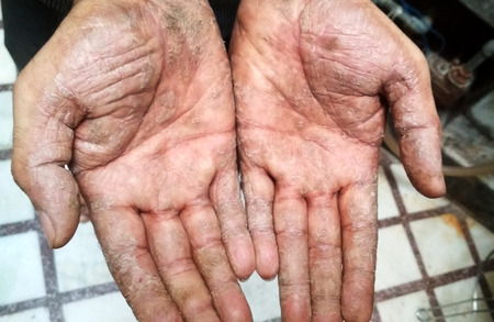 Psoriasis disease on the man's hand. Hard, cracked skin on the inside of the male hand. Cracked, flaky skin on the palm of your hand. Dermatological problems of psoriasis.の写真素材