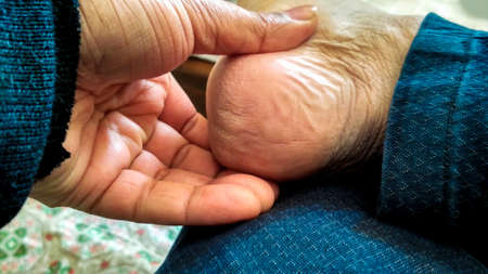A man shows his dry dirty Cracked heels