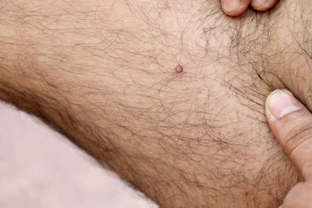 A closup of pimple on man's thigh