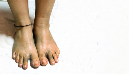 Close-up top view of a pair of human feet showing visible swelling, discoloration, and possible...