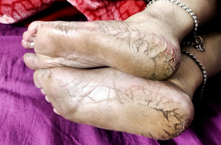High-resolution close-up image of dry, cracked heels and soles of bare feet, highlighting skin...