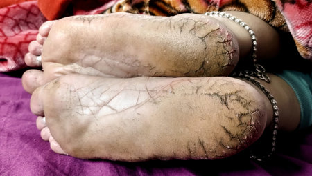 High-resolution close-up image of dry, cracked heels and soles of bare feet, highlighting skin...