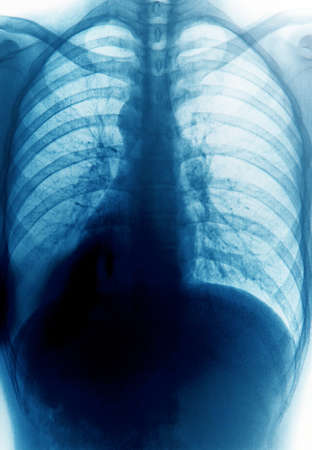 x-ray of chest of human