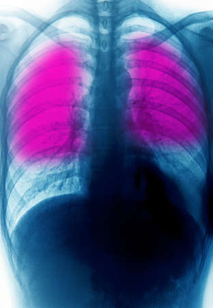 x-ray of chest of humanの写真素材