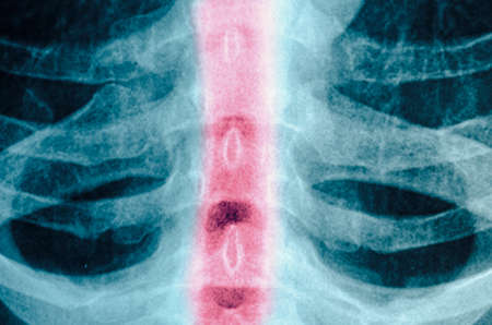 x-ray of chest of humanの写真素材