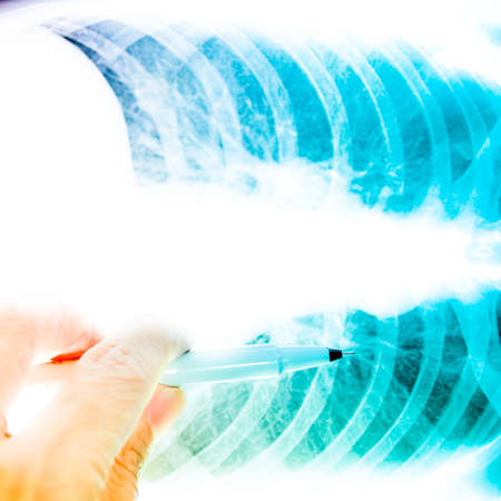 showing x-ray picture of human lumbar vertebra boneの写真素材