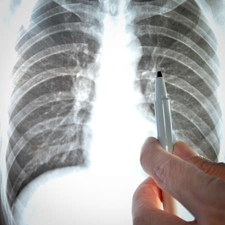 showing x-ray picture of human lumbar vertebra boneの写真素材
