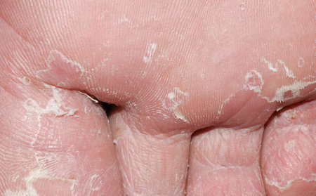 dry skin texture detail of human foot