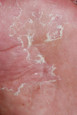 dry skin texture detail of human footの写真素材