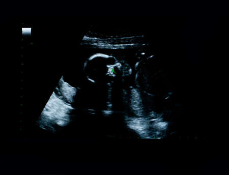 Film Ultrasound of the skull and baby's brain in the womb of mother. Health care and antenatal care ...