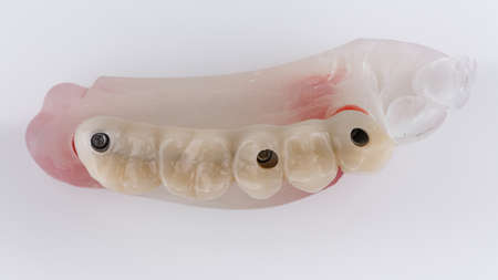 Dental prosthesis on five chewing teeth with model, top view on white background