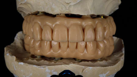 Dental prostheses for the patient. Prostheses in bite on the model
