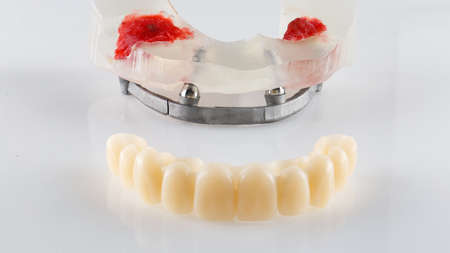 Temporary prosthesis of the upper jaw and beam on the model, photo on a white background