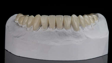 Crowns and veneers from high-quality ceramics for vice jaws on a model on a black background
