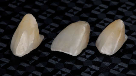 Three ceramic veneers of central cutters on a textured black background