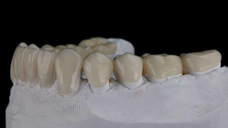 Ceramic Dental Crowns on a gypsum model on a black background