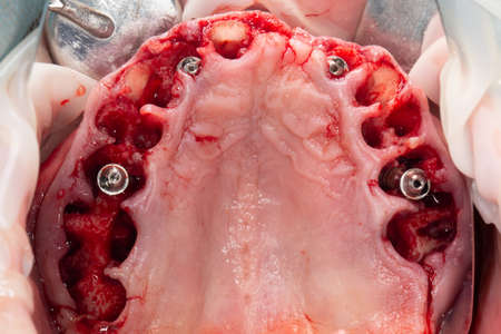 Cutting the gums of the upper jaw and the installed Dental implants