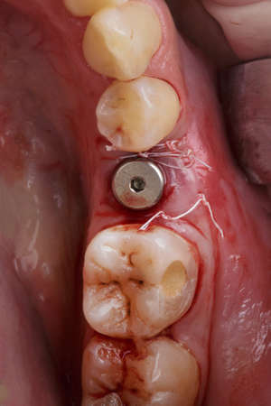 Installed Dental Implant and gum shaper in the field of chewing tooth