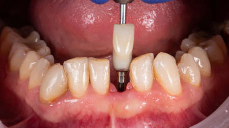 The moment before installing the ceramic crown of the central cutter of the lower jaw