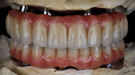 Prostheses with pink gums from ceramics for upper and lower jaws on plaster modelsの写真素材