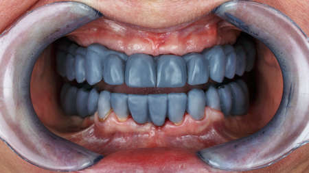 dental wax up blue two jaws for diagnosis and creation of prostheses