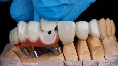 doctor's hand installs dental veneer on hybrid prosthesis bridge on black background