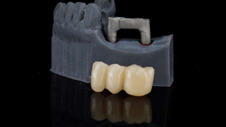 temporary dental bridge with model and beam on black background